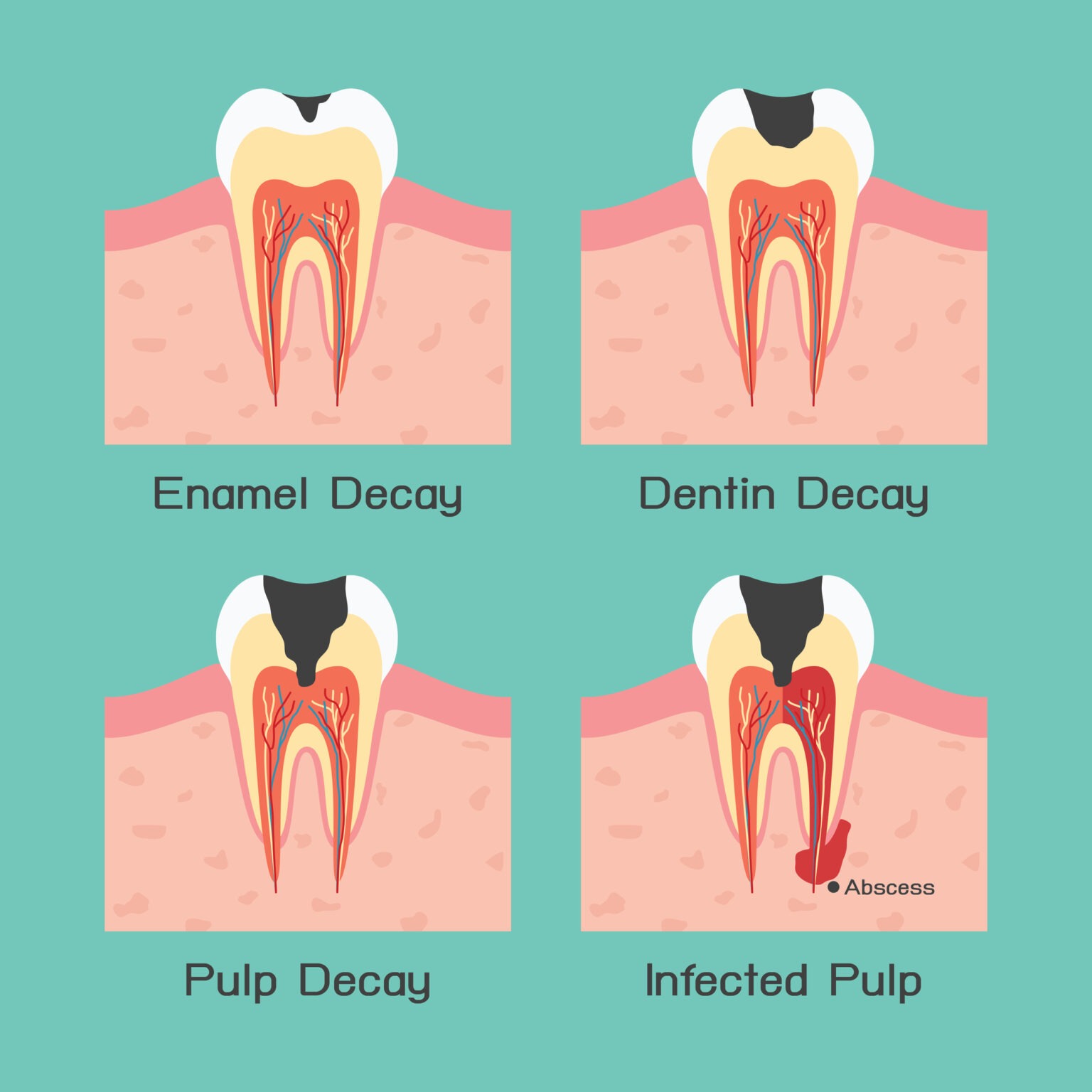 Tooth decay, vector