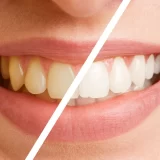 Teeth Whitening
