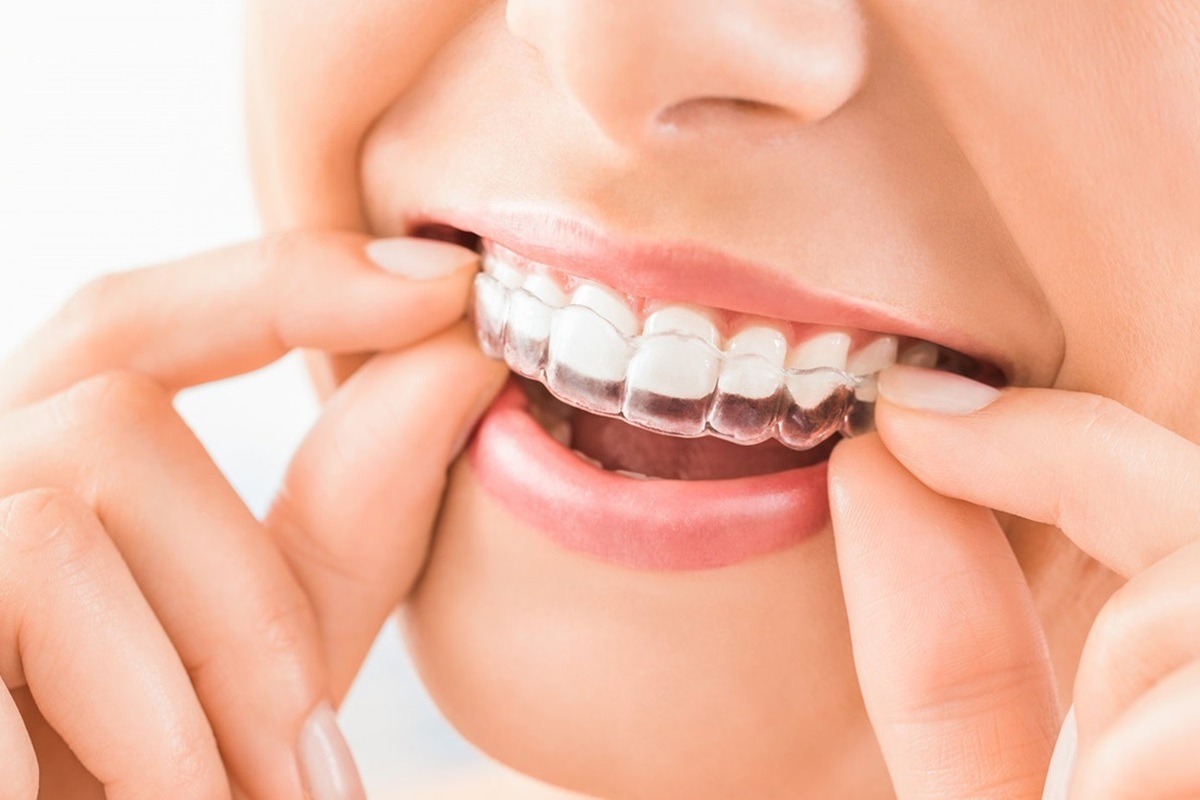https://drsamapradhan.com.np/wp-content/uploads/2023/11/clear-braces-ialign-nepal.jpg