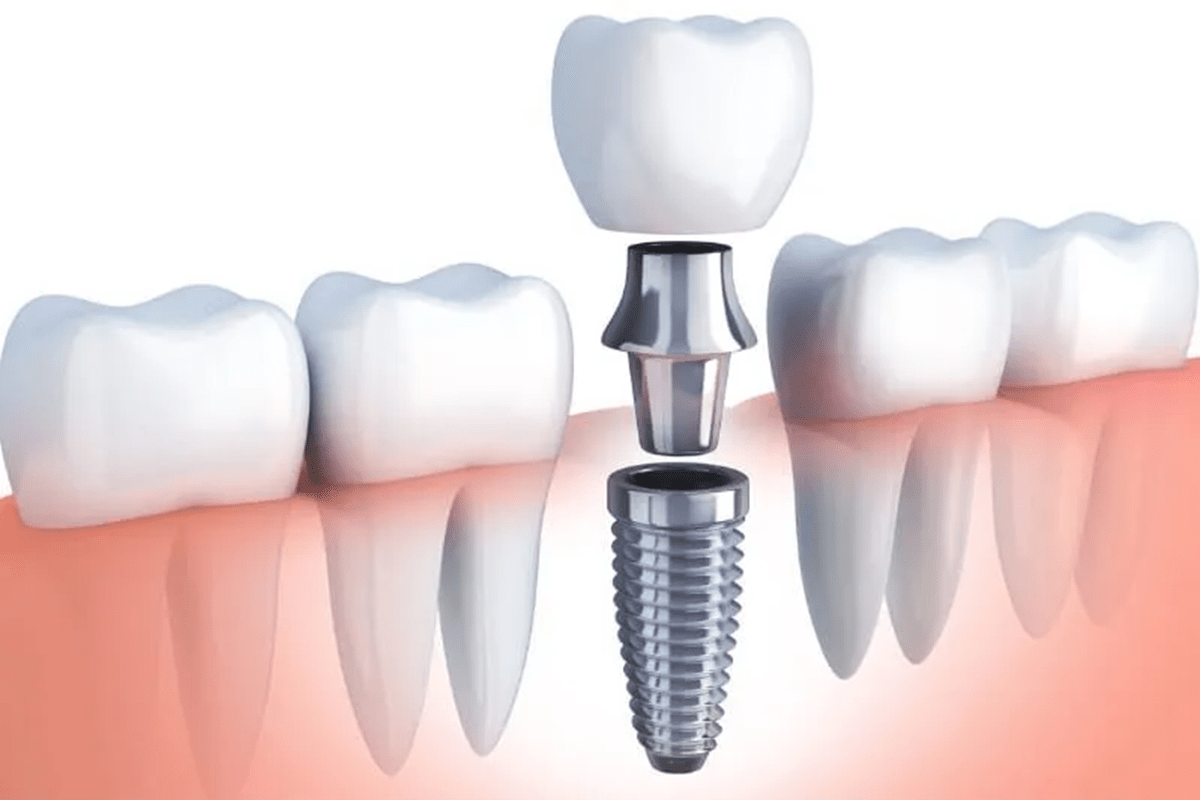 https://drsamapradhan.com.np/wp-content/uploads/2023/11/dental-implant-nepal.png